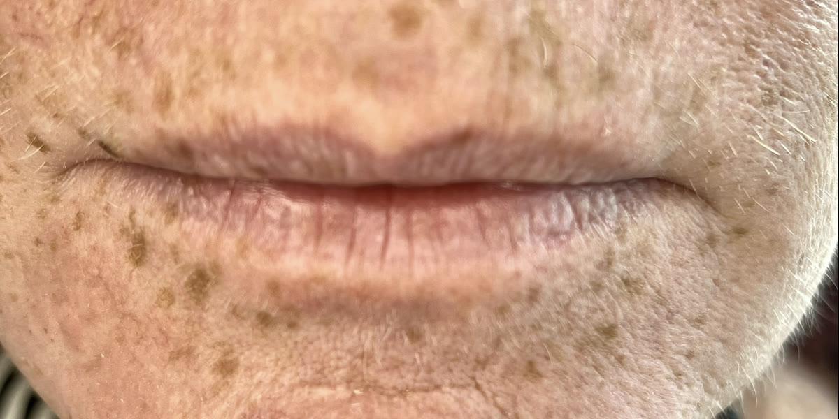 Lippen vor der Pigmentierung, natürlicher Ton